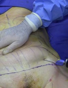 Fat_removal_using_cannula_during_tumescent_liposuction